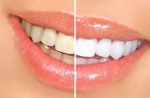 Zoom (Teeth Whitening)