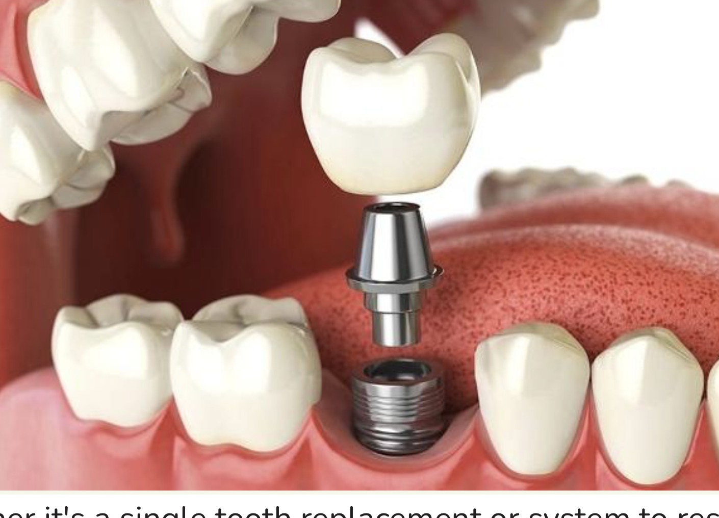 Implants Restoration